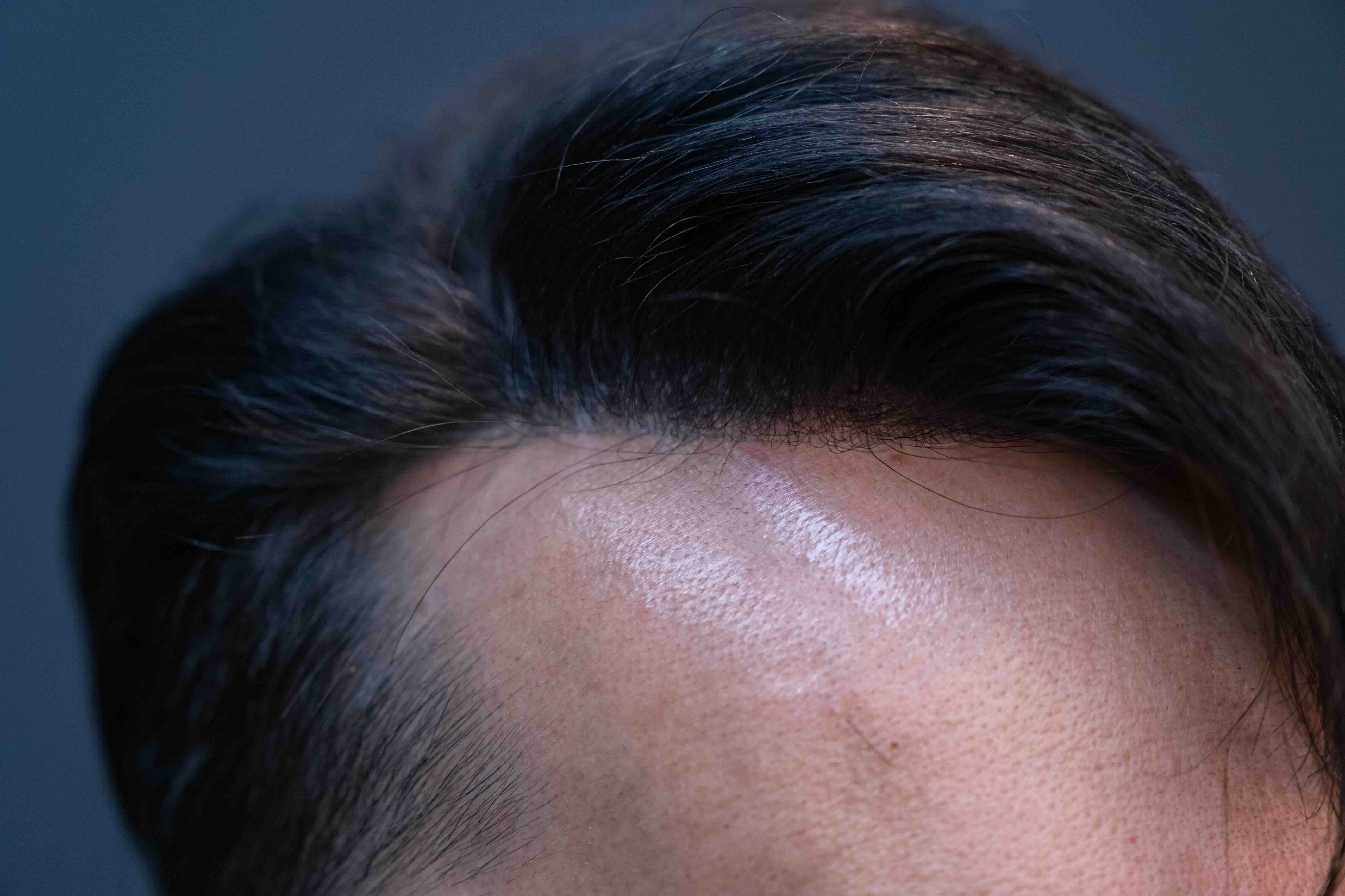 Natural-Looking Hairline